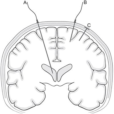 Monitoring and Measurement of Intracranial Pressure in Pediatric Head Trauma